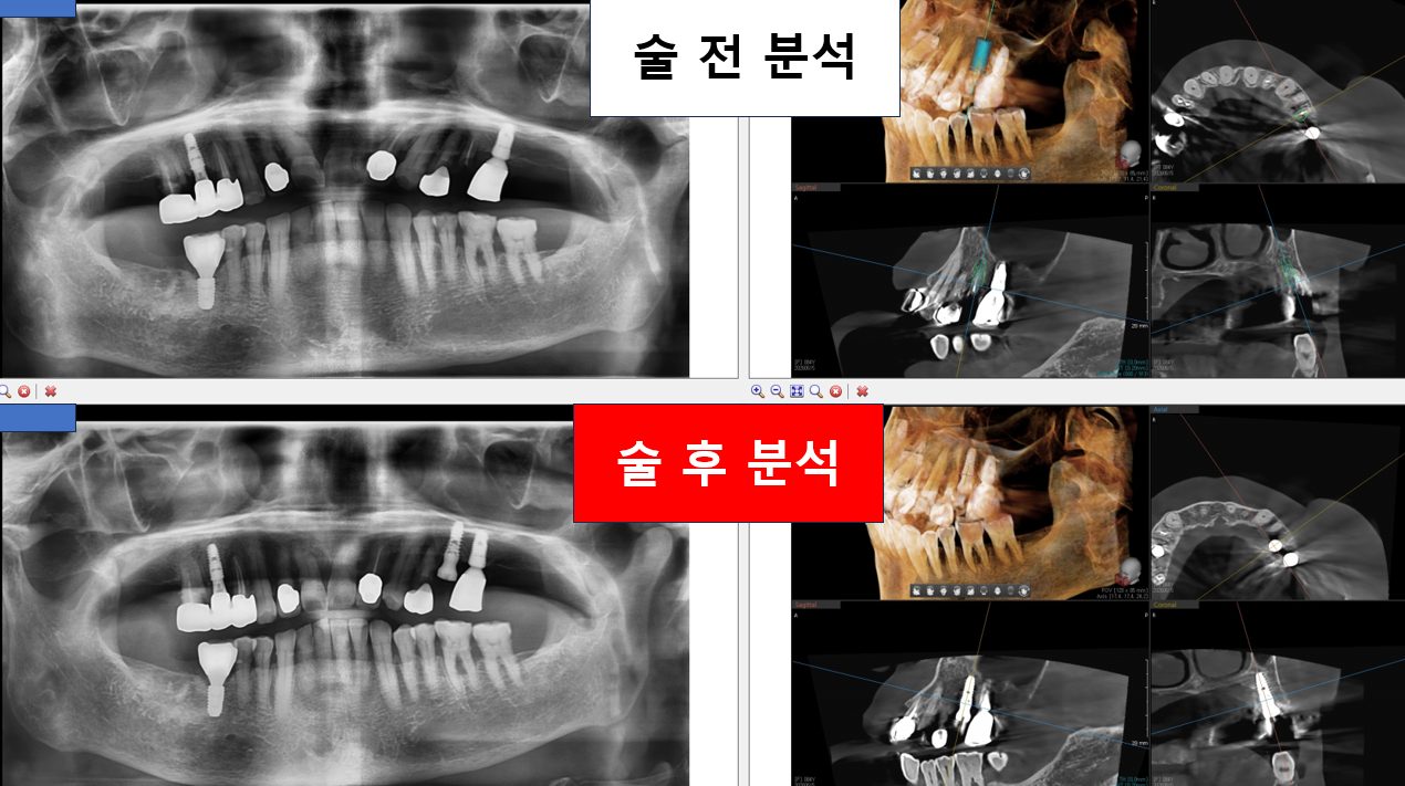 임플란트 수술 전 계획과 수술 후 결과를 비교한 3D CT 화면